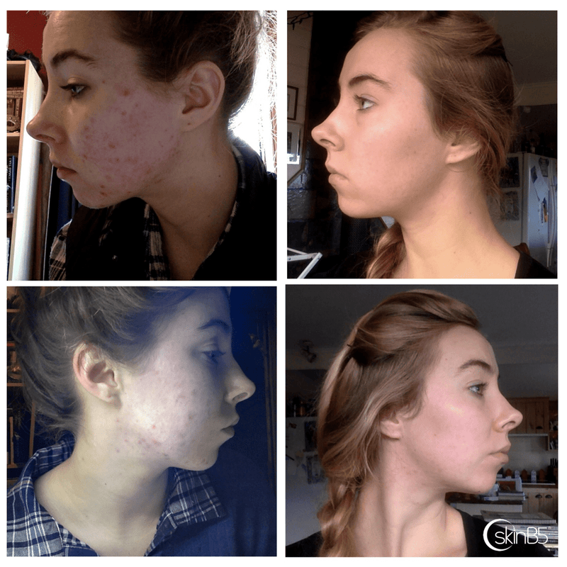 SKINB5 Acne Control 60T - Go Vita Burwood